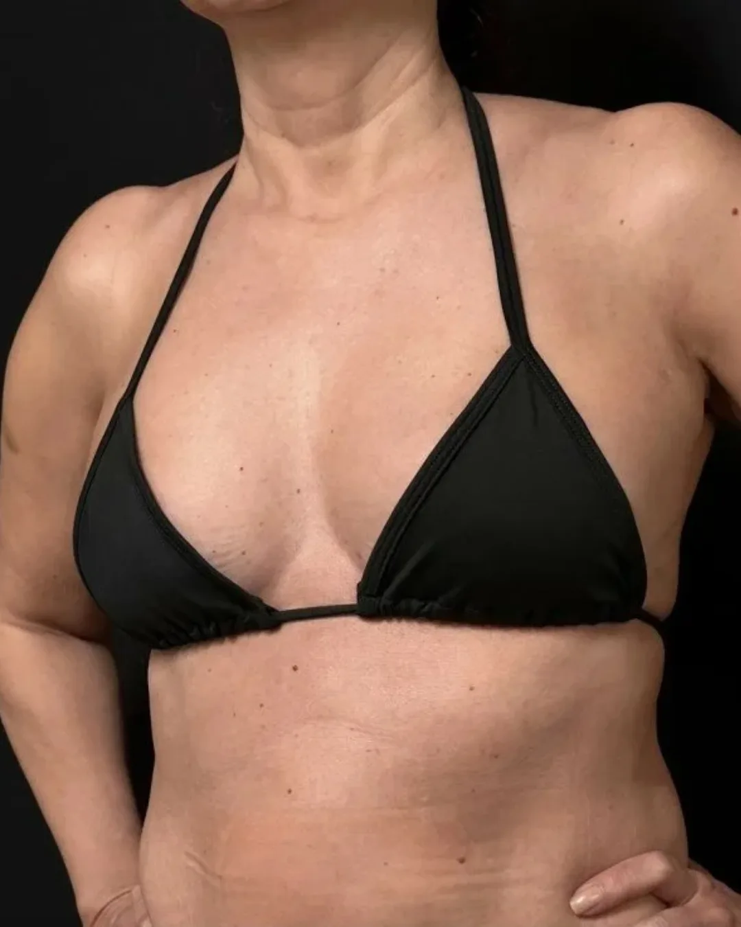 Fotografia ilustrativa para a seção Como funciona de Explante de Silicone